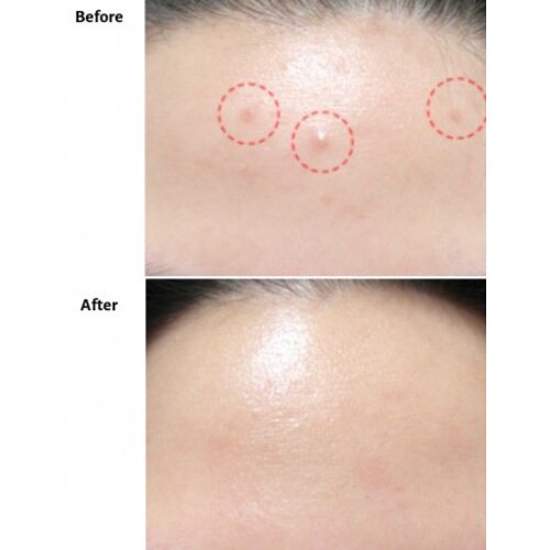 Ciracle Red Spot Cream