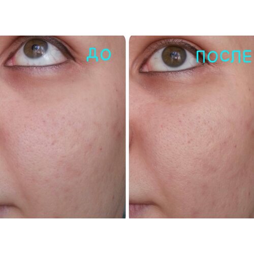 MediHeal P.D.F AC-Dressing Ampoule Mask