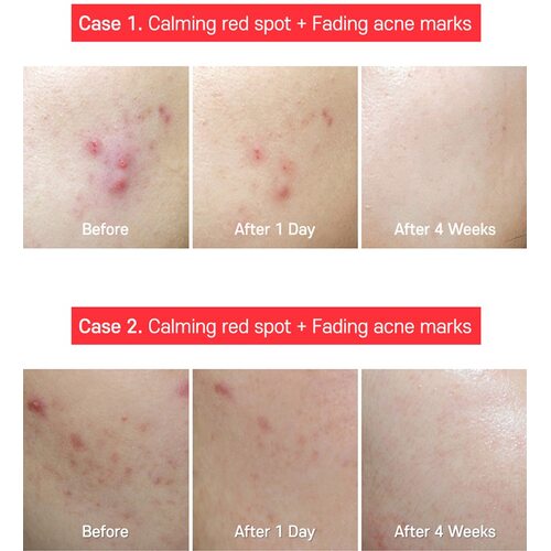 Tiam AC Fighting Spot Rx Cream