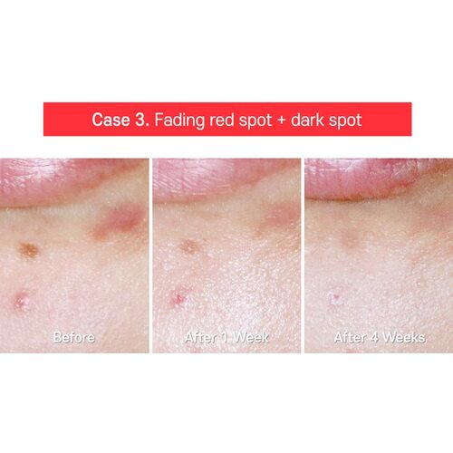 Tiam AC Fighting Spot Rx Cream
