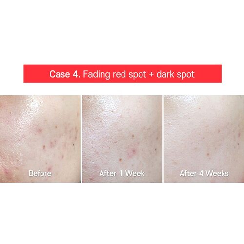 Tiam AC Fighting Spot Rx Cream