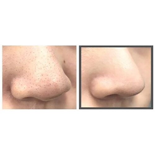 Some by mi Charcoal BHA Pore Clay Bubble Mask