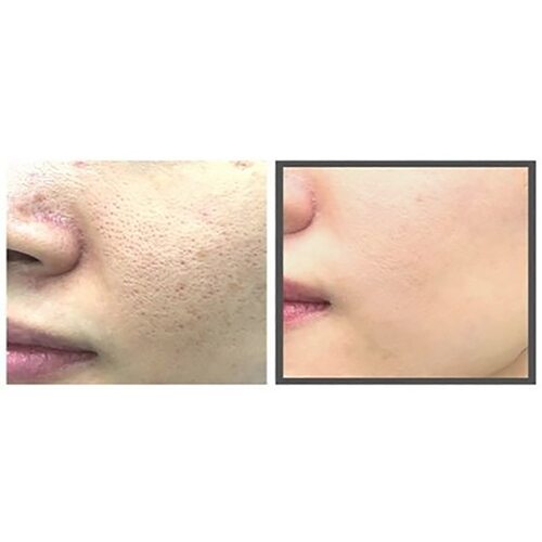 Some by mi Charcoal BHA Pore Clay Bubble Mask