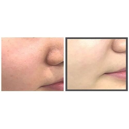 Some by mi Charcoal BHA Pore Clay Bubble Mask