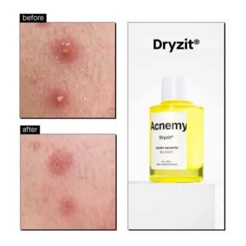 Acnemy Dryzit