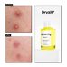 Acnemy Dryzit