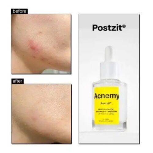 Acnemy Postzit