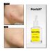Acnemy Postzit