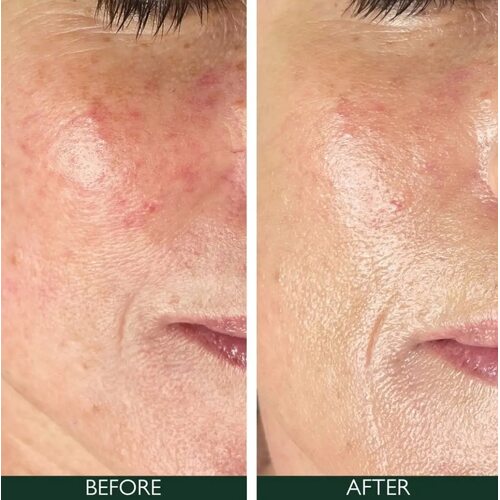 Sorted Skin 5 In 1 Anti-Redness Day Cream