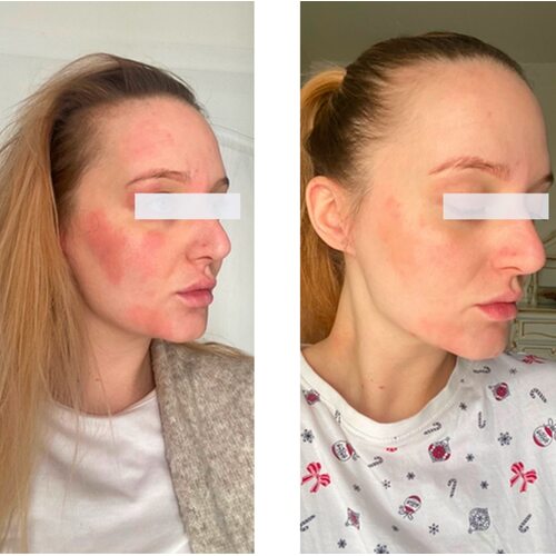 Sorted Skin Intensive Rescue Spray