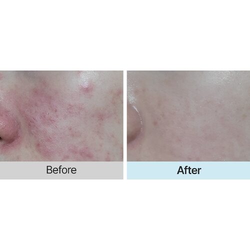 Hyaah Allinone Ectoin Lotion