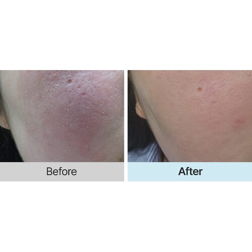Hyaah Allinone Ectoin Lotion