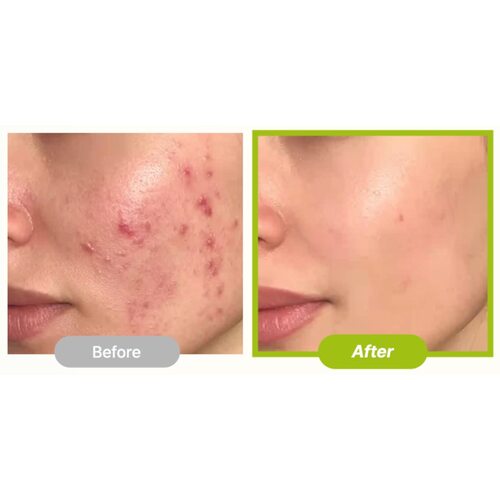 Purito Seoul Azelaic Acid 10 Kojic Tea Tree Serum