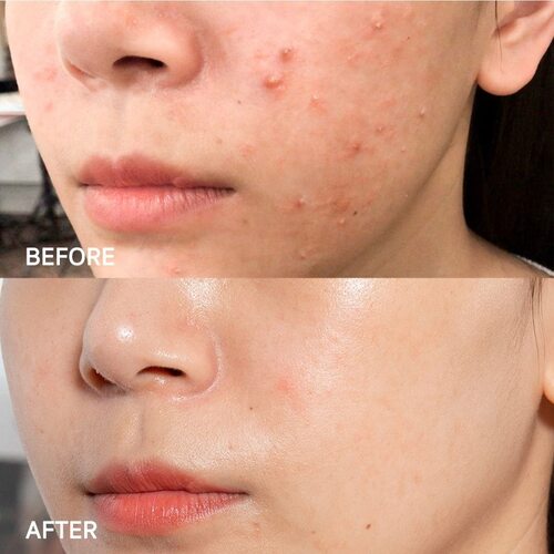 Some by mi Super Miracle Spot All Kill Cream
