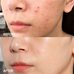Some by mi Super Miracle Spot All Kill Cream