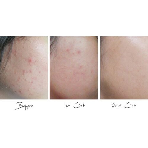 Etude House AC Clean Up Daily Acne Cleansing Foam